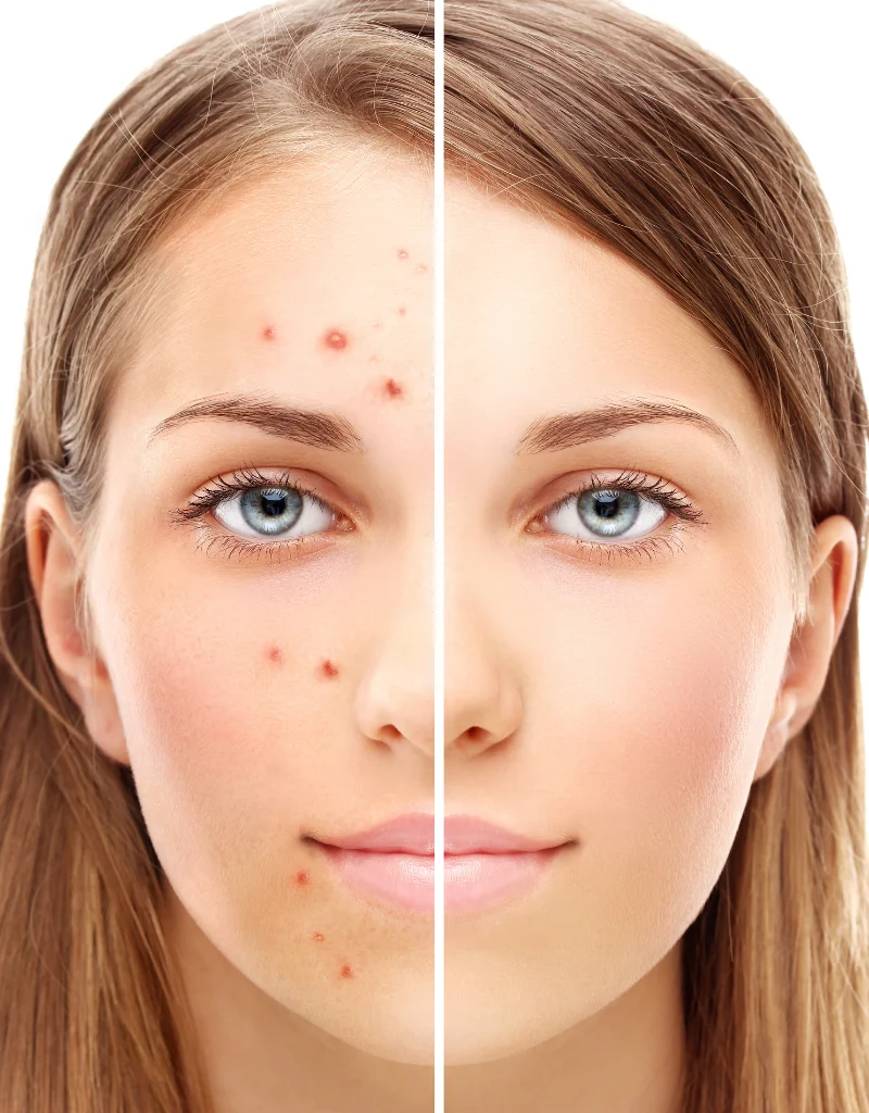 Akne Bakımı